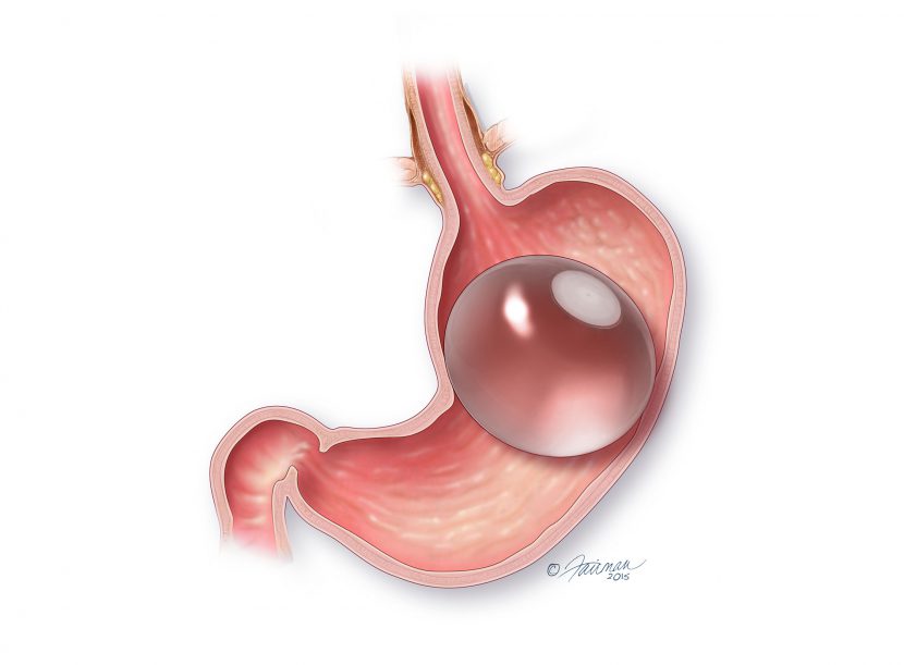 ORBERA™ IN THE STOMACH